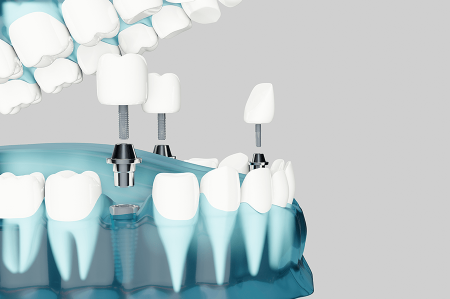 Reconstruccion dental que es cuando es necesaria